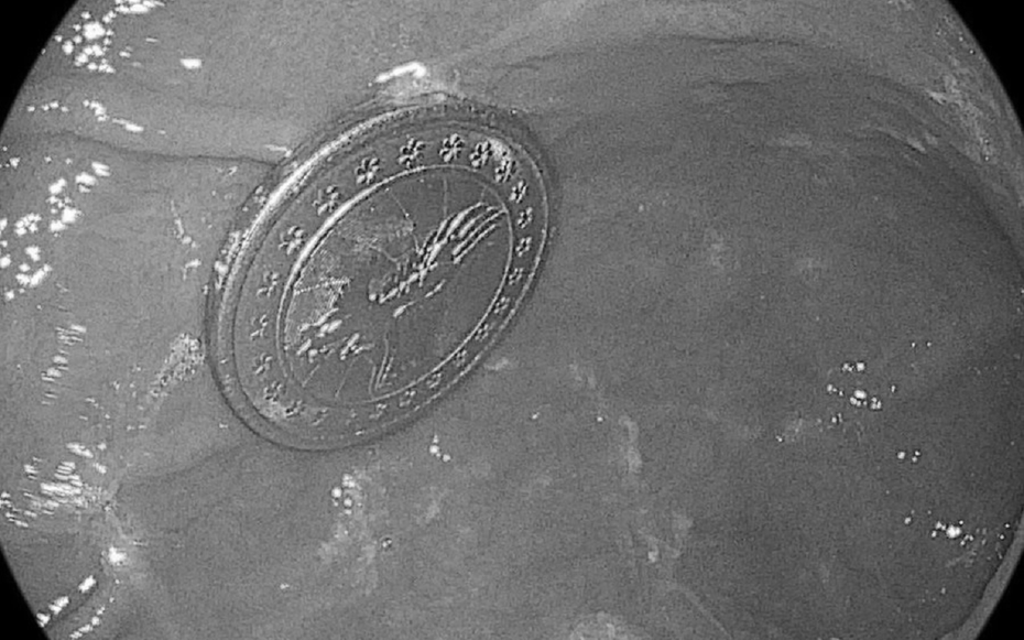 Bé trai 2 tuổi ho to liên tục, bác sĩ gắp ra thứ "đáng sợ" bên trong