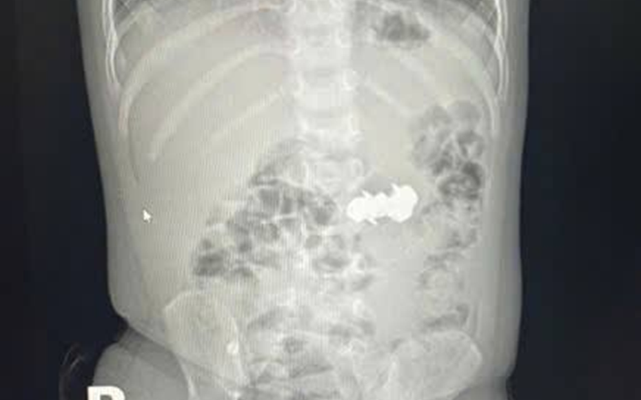 Bé trai 2 tuổi được gia đình đưa đi viện, bác sĩ gắp ra thứ "đáng sợ" bên trong