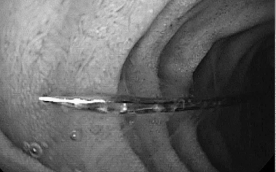 Bé trai 11 tuổi khóc kêu đau, bác sĩ gắp ra thứ "đáng sợ" bên trong