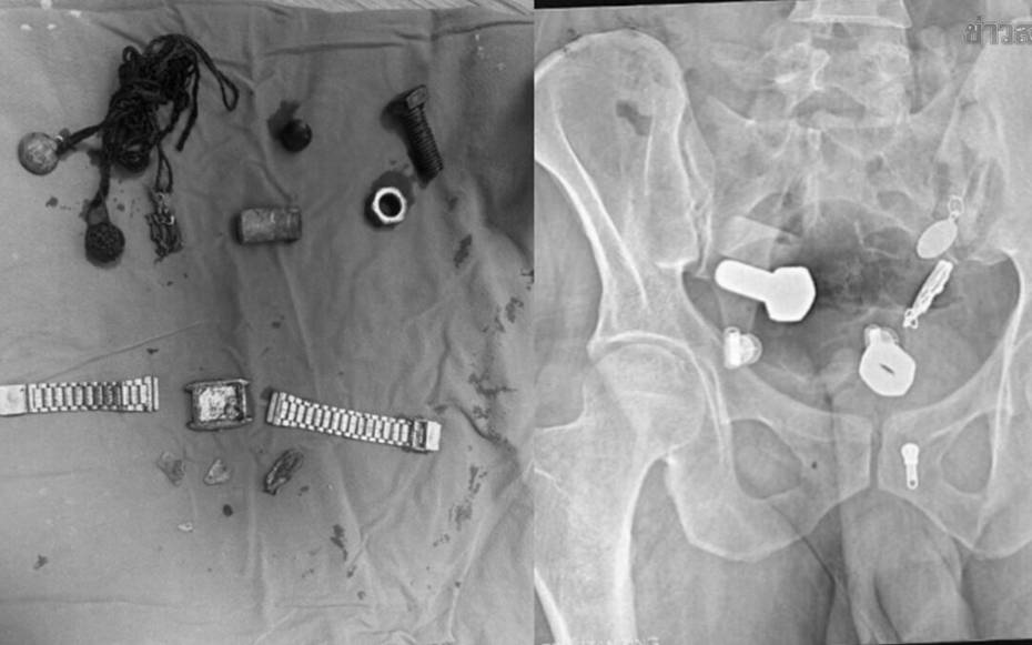 Người đàn ông liên tục đau bụng, bác sĩ sốc nặng khi phát hiện "bí mật" đáng sợ