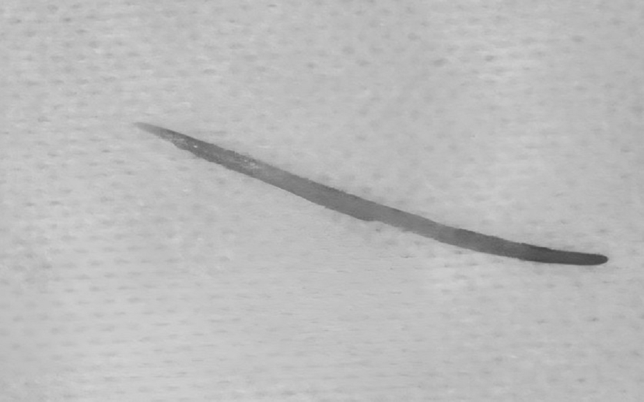 Người đàn ông 57 tuổi đau bụng thốc ngược lên, bác sĩ gắp ra thứ "đáng sợ" dài 5cm