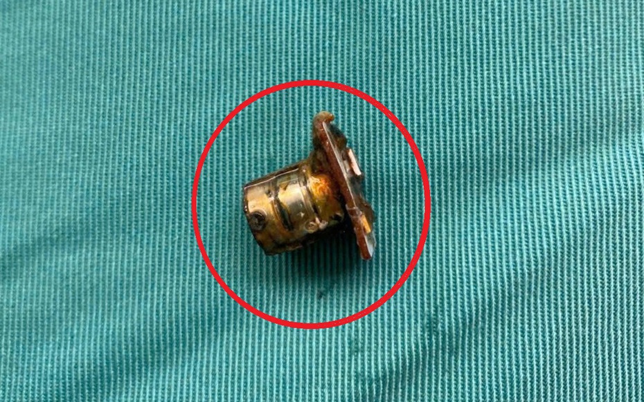 Bé 2 tuổi đang chơi bỗng ho tím tái, bác sĩ gắp ra thứ "đáng sợ" trong bụng