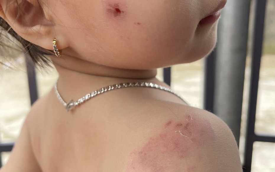 Nhà trường báo cáo gì về vụ bé gái 2 tuổi bị nhiều vết cắn khi học ở lớp?