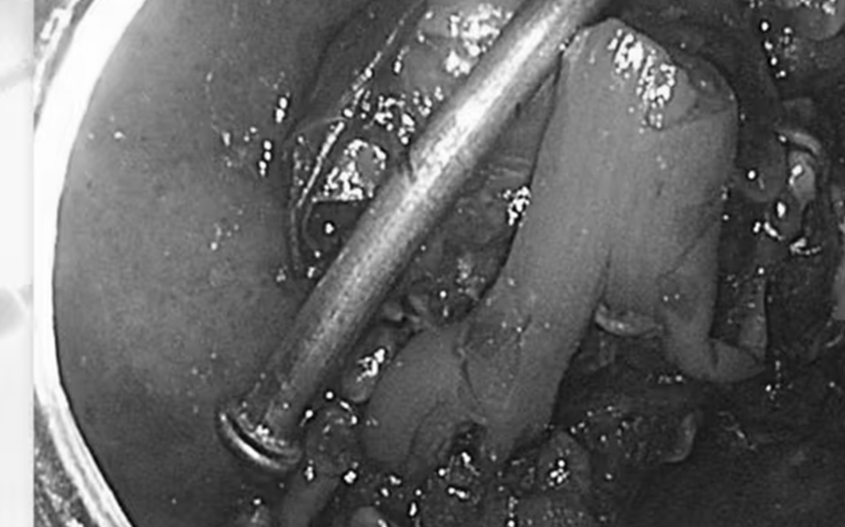 Bé trai 8 tuổi nghịch dại, bác sĩ kinh ngạc phát hiện thứ "đáng sợ" bên trong bụng