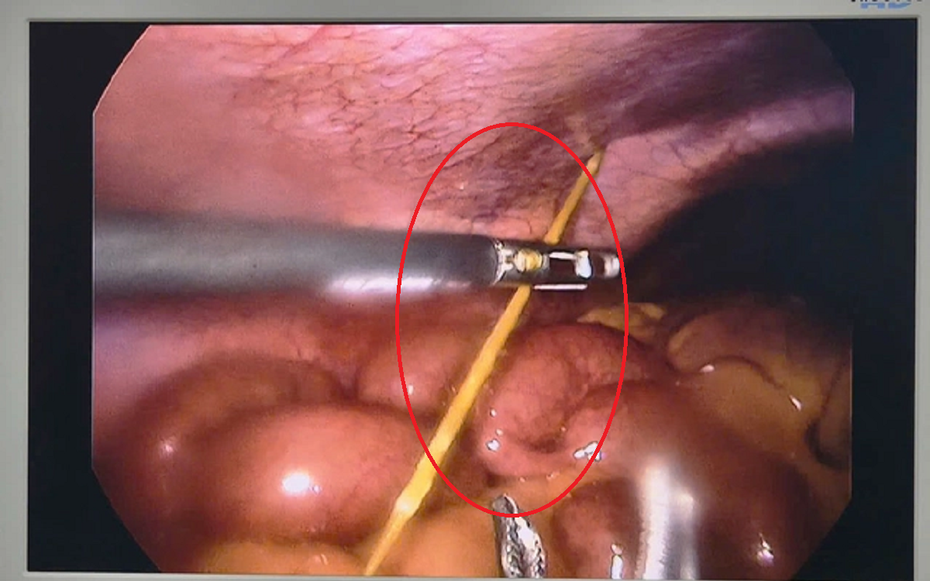 Đau bụng dữ dội, bác sĩ phát hiện thứ "đáng sợ" bên trong