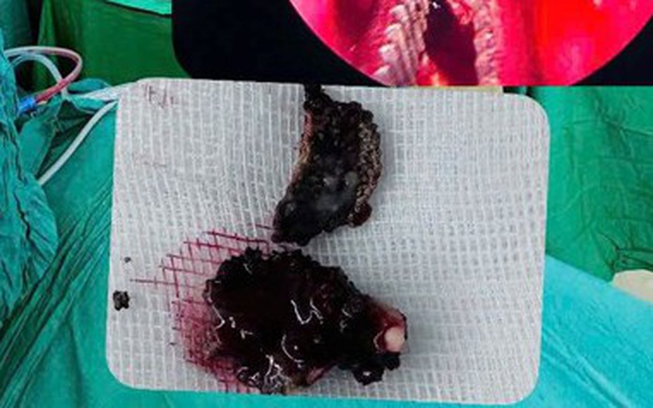 Chảy nước mũi hôi nhiều năm, bệnh nhân 23 tuổi đi khám bác sĩ gắp ra thứ "đáng sợ"