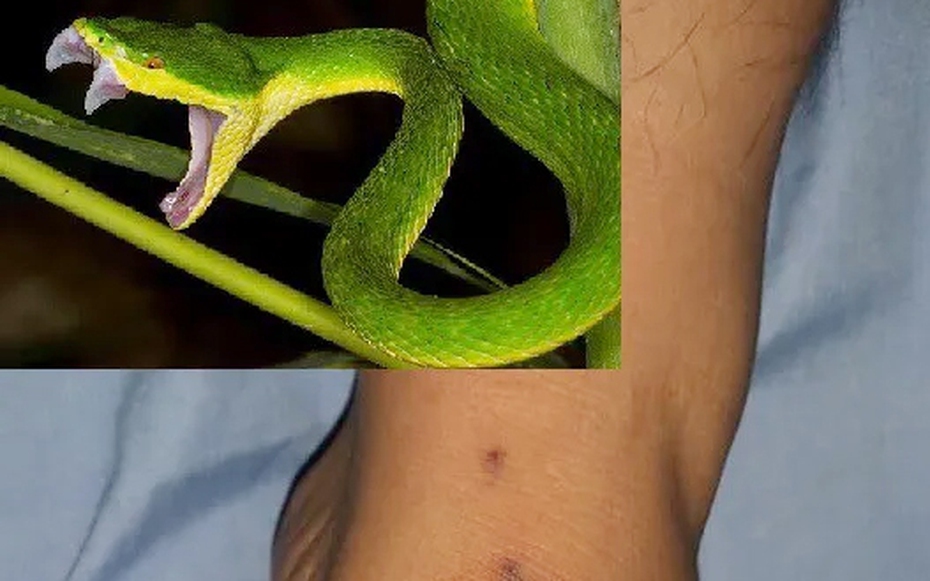 Bị rắn cắn, người đàn ông nguy kịch do tự đắp thuốc để "hút độc"