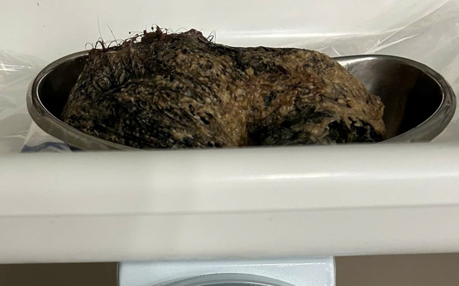 Bé gái 6 tuổi đau bụng dữ dội, bác sĩ gắp ra thứ "đáng sợ"