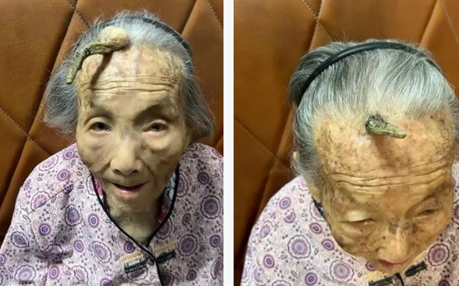 Cụ bà 107 tuổi bỗng mọc "sừng" trên trán, cộng đồng mạng bàn tán đưa ra lời khuyên