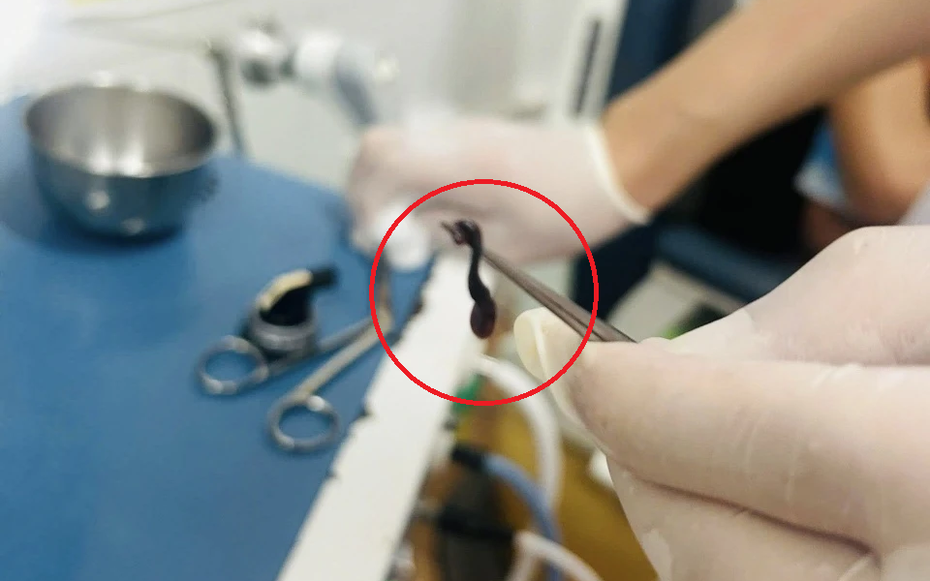 Thấy chảy máu mũi kéo dài, bé trai đến viện bác sĩ gắp ra thứ "đáng sợ"