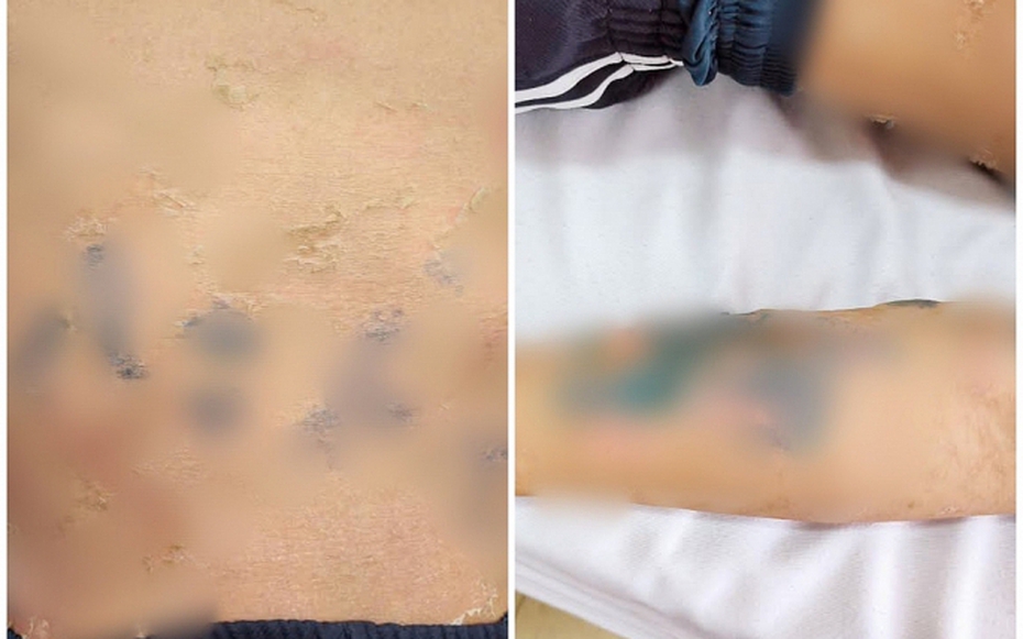 Tự đắp lá chữa bệnh sởi, nam thanh niên 17 tuổi nhập viện gấp