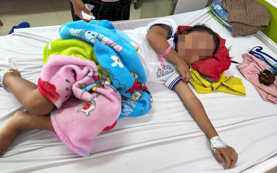 Cháu bé 7 tuổi nhập viện với 200 vết ong đốt gây bội nhiễm, tổn thương giác mạc