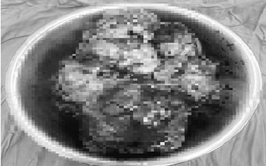 Cắt bỏ khối u dạ dày “khủng” nặng 3,7kg cho bệnh nhân nữ từng sợ …mổ
