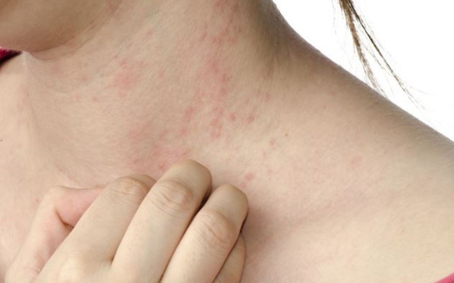 Đi khám vì bị ngứa khắp người, người phụ nữ sốc nặng trước thông báo của bác sĩ