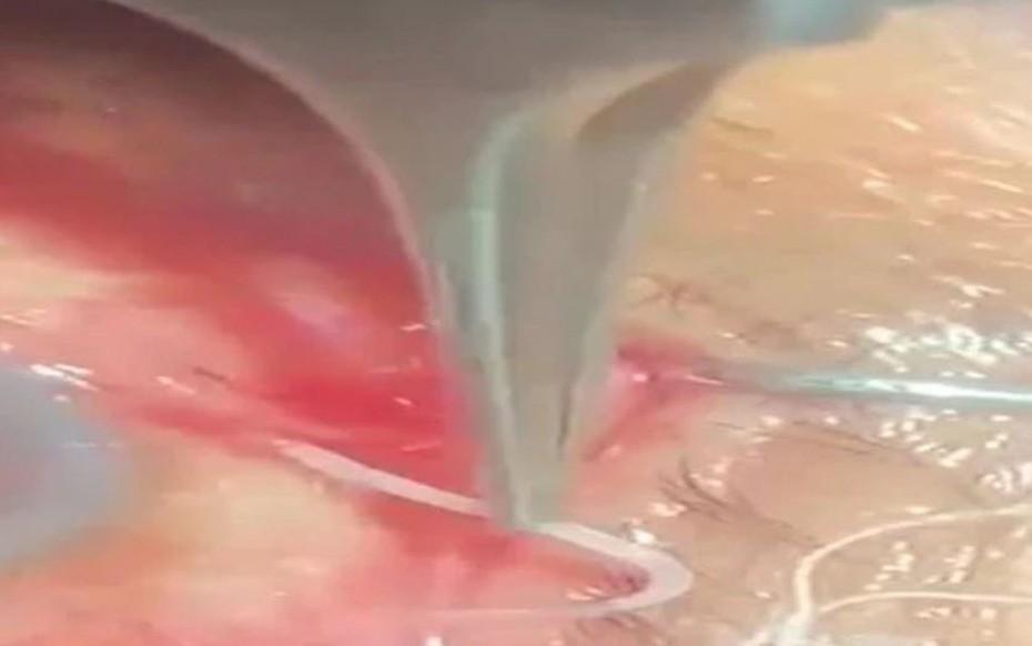 Người đàn ông 60 tuổi đau nhói ở mắt, bác sĩ sốc nặng khi phát hiện "thứ đáng sợ" bên trong