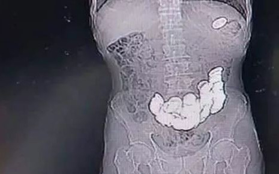 Người đàn ông 33 tuổi bụng phình to như quả bóng, bác sĩ gắp ra thứ "đáng sợ" bên trong
