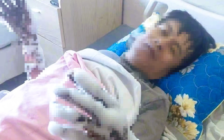 Bị phóng điện, người đàn ông bỏng nặng cả hai tay