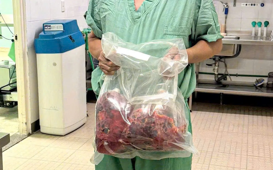 Lần đầu tiên tại Việt Nam: Cắt bỏ hai thận đa nang nặng gần 10kg, ghép thận thành công trong một ca mổ