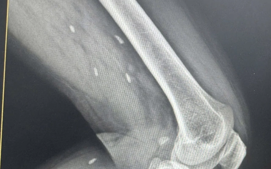 Thói quen nhiều người Việt mê mẩn khiến sán “làm tổ” dưới da mà không hay biết