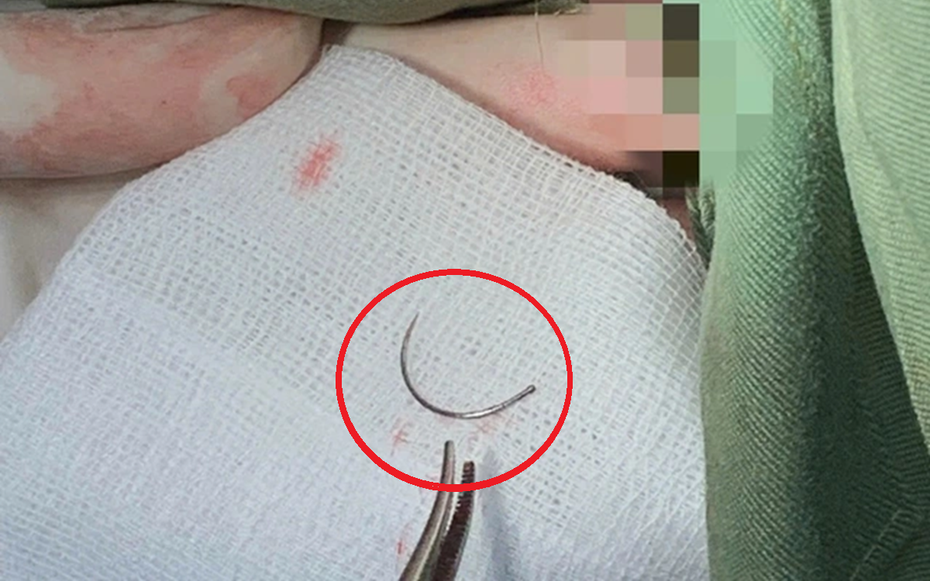 Kim khâu “mắc kẹt” suốt 11 năm trong cơ thể, người phụ nữ đến viện cầu cứu