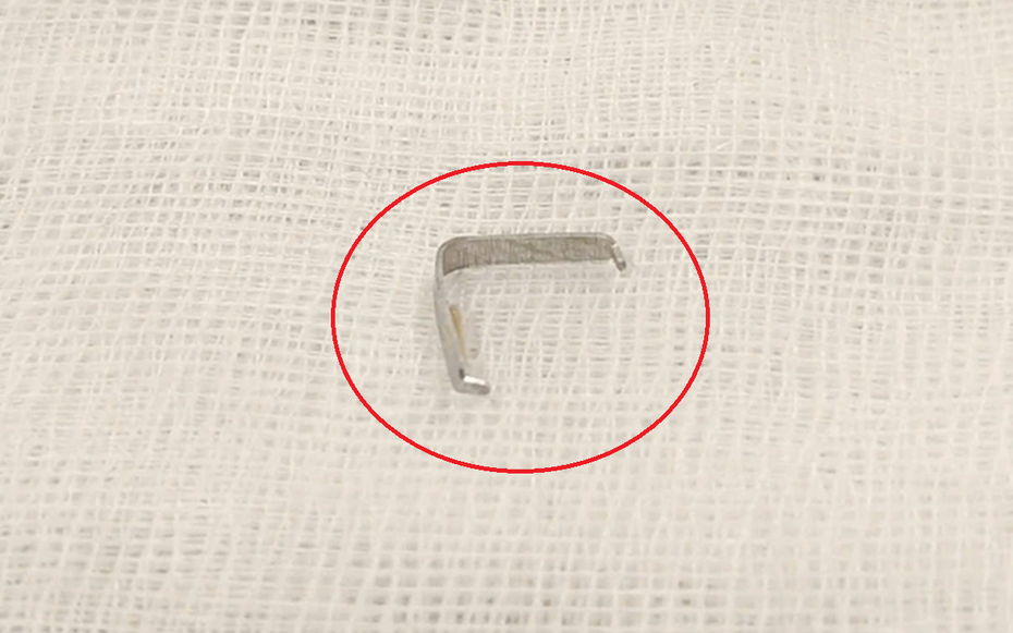 Bé trai 1 tuổi cứ ăn là nôn ọe, bác sĩ phát hiện "bí mật" bên trong