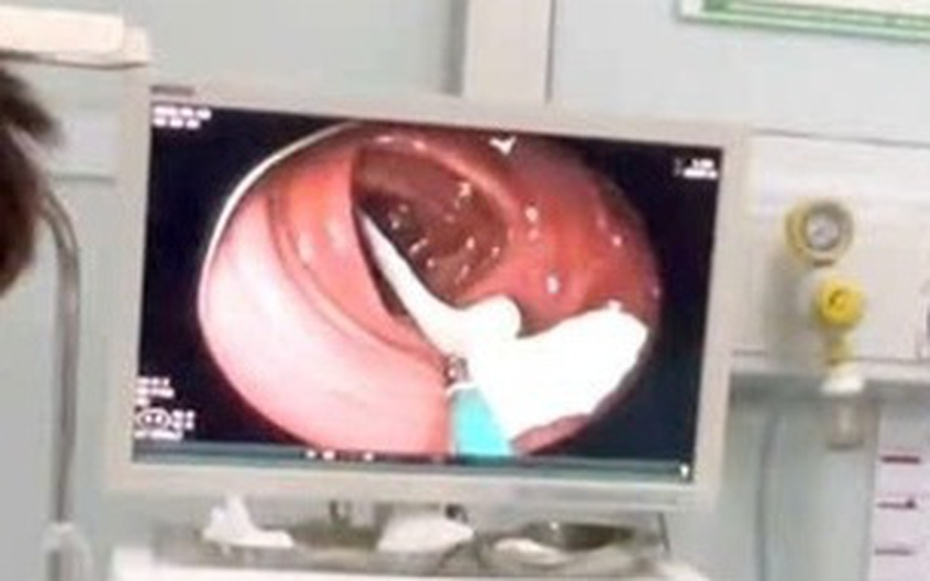 Người đàn ông 35 tuổi sốc nặng khi thấy ký sinh trùng "khổng lồ" đang sống trong ruột