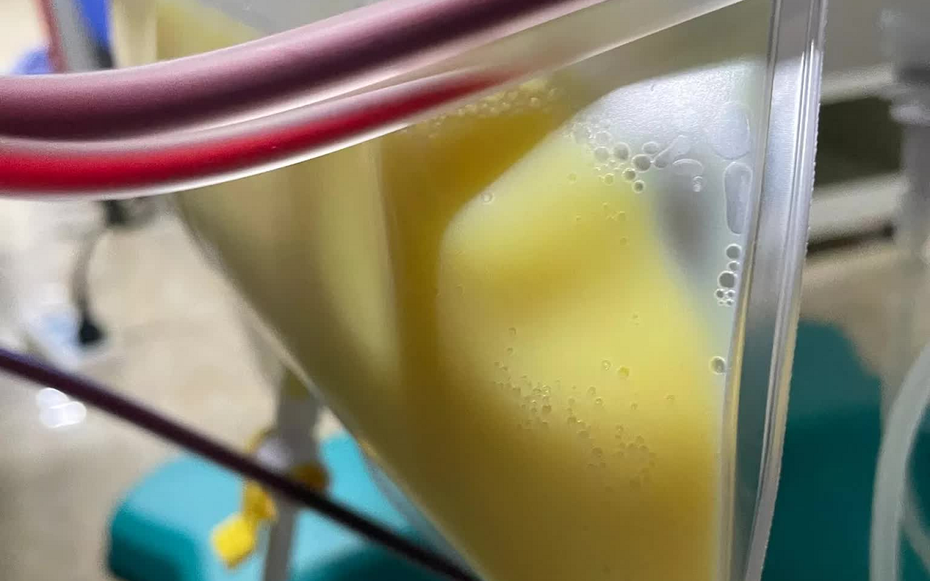 Người phụ nữ 30 tuổi "máu trắng đục như sữa" vì thói quen nhiều người mắc mà không hay