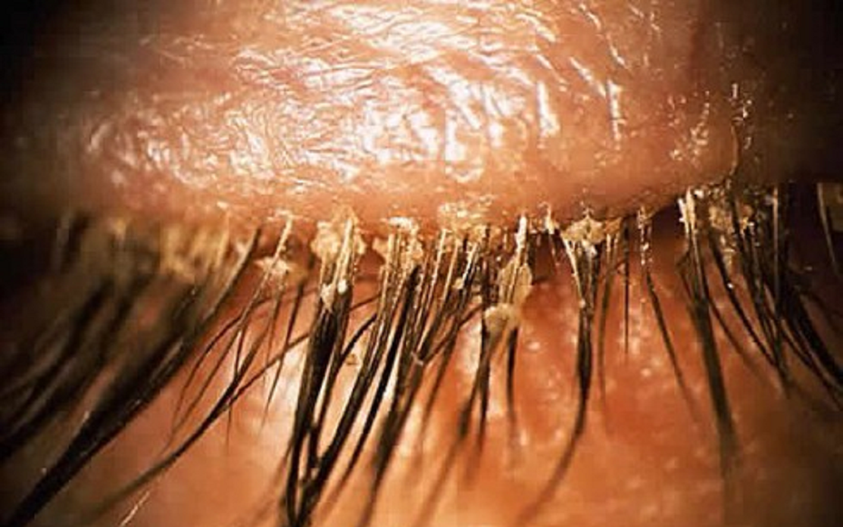 Người phụ nữ 24 tuổi khó chịu ở mí mắt, bác sĩ sốc khi gắp ra thứ "đáng sợ" chi chít trên mi