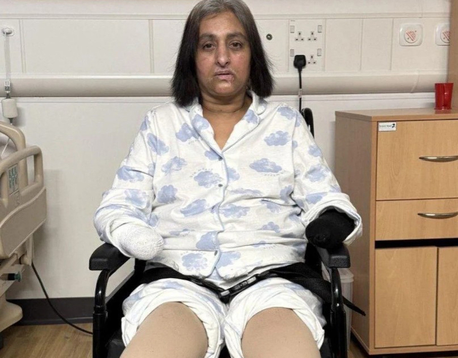 Bị chó cưng liếm, người phụ nữ "sốc" khi phải cắt cụt tay chân