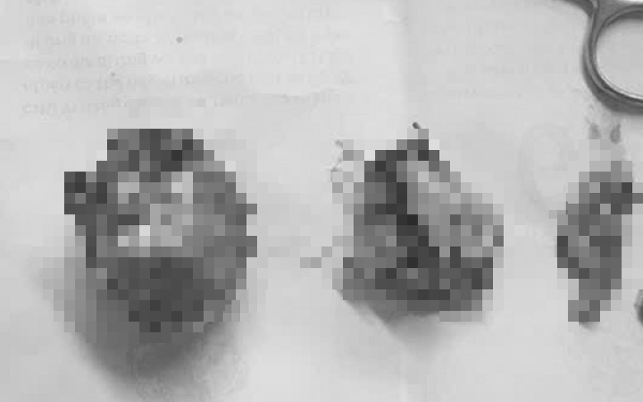 Người phụ nữ 66 tuổi đau bụng kéo dài, bác sĩ gắp ra thứ "đáng sợ"