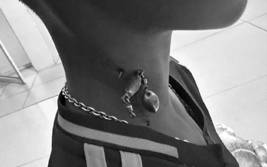 Bé trai 13 tuổi chảy máu nhiều, bác sĩ sốc khi phát hiện bí mật "đáng sợ" ở cổ