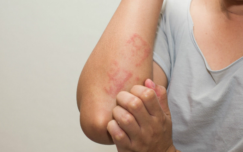 Ngứa không dứt, người phụ nữ 37 tuổi phát hiện cơ thể nhiễm tới 5 loại ký sinh trùng