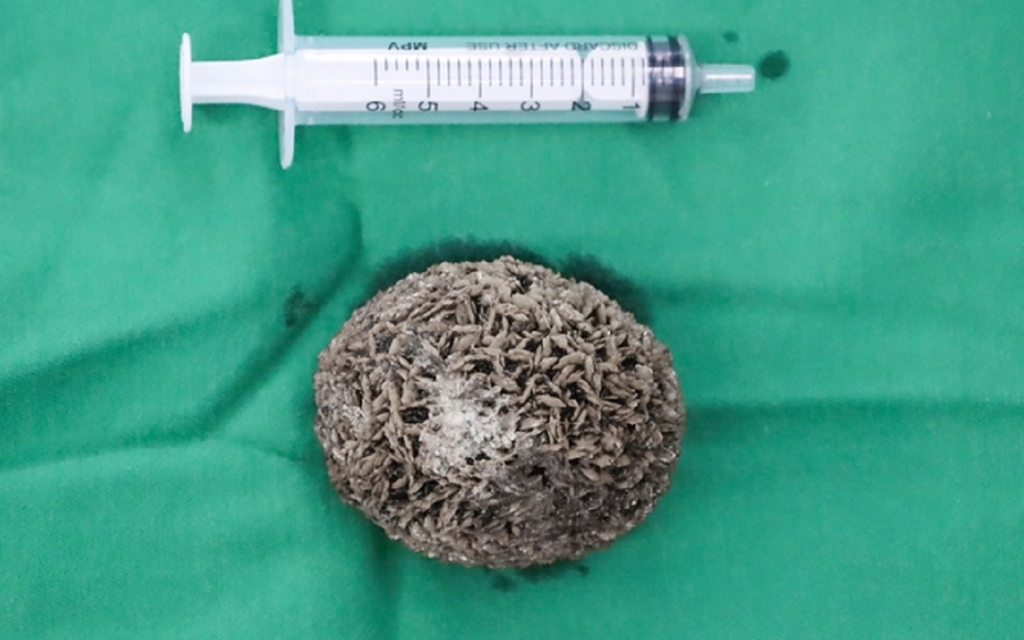 Người đàn ông 50 tuổi đau hạ vị kéo dài, bác sĩ sốc khi gắp ra thứ "đáng sợ" bằng quả trứng ngỗng