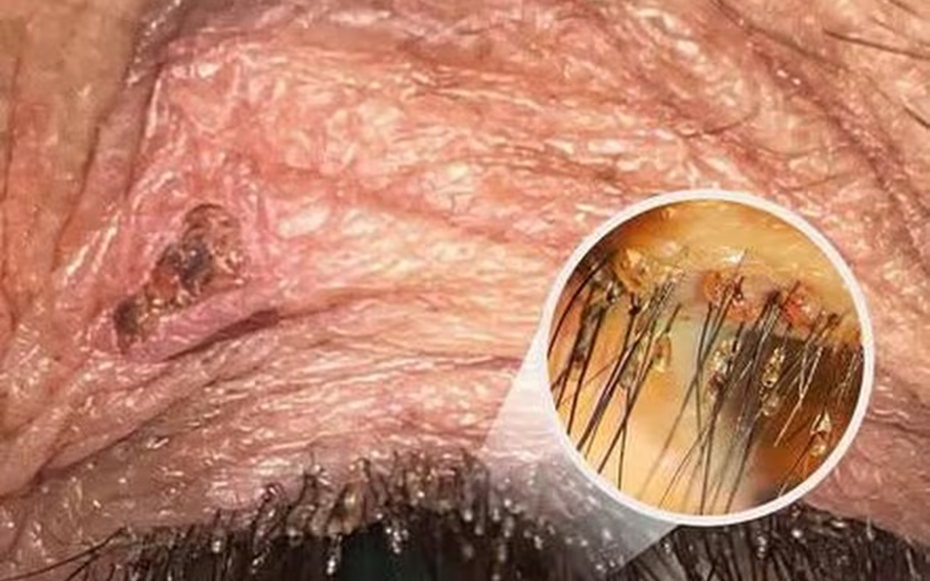 Ngứa mắt khó chịu, người bệnh sốc khi bác sĩ tìm thấy “thủ phạm” ở bờ mi