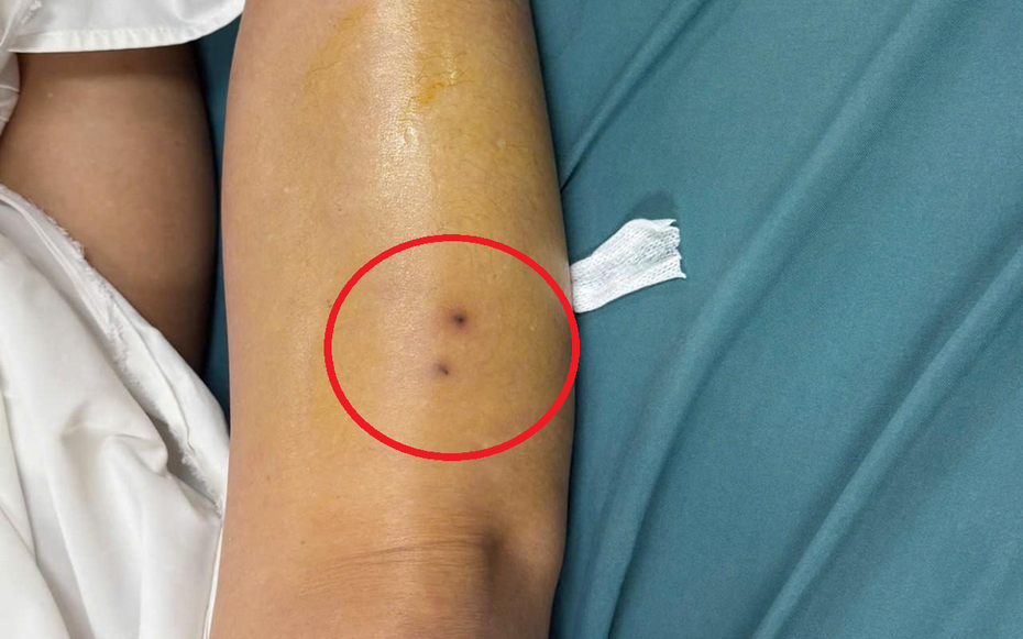 Suýt mất mạng vì rắn độc, người phụ nữ hồi phục thần kỳ sau 1 ngày điều trị