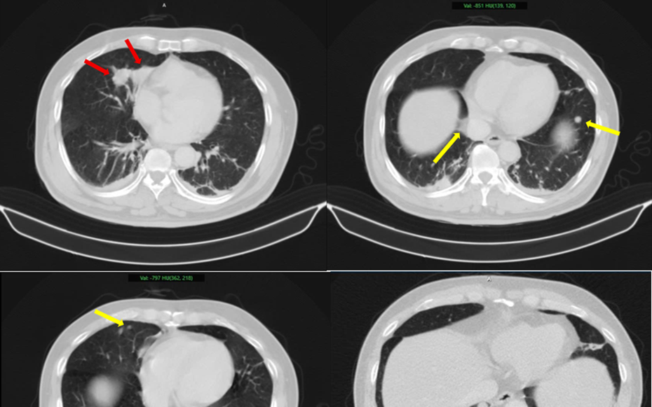 Người đàn ông 63 tuổi sốc nặng khi phát hiện mắc hai bệnh ung thư cùng lúc