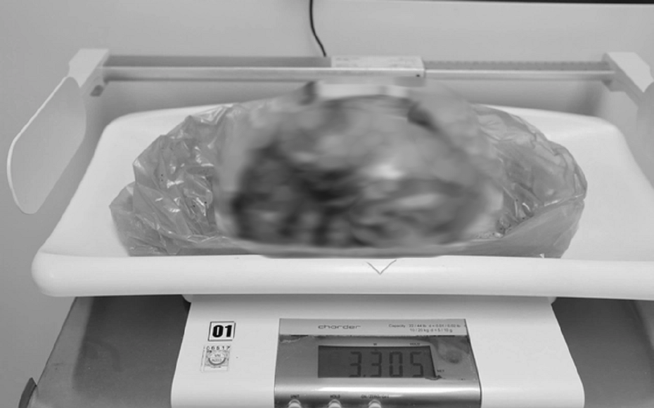 Phát hiện "thứ đáng sợ" nặng hơn 3kg trong bụng người phụ nữ 42 tuổi