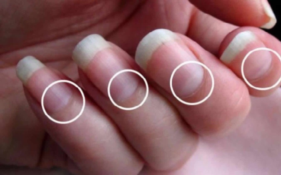 7 dấu hiệu bất thường ở móng tay có thể “tố cáo” bệnh tim, phổi, thận, tuyến giáp