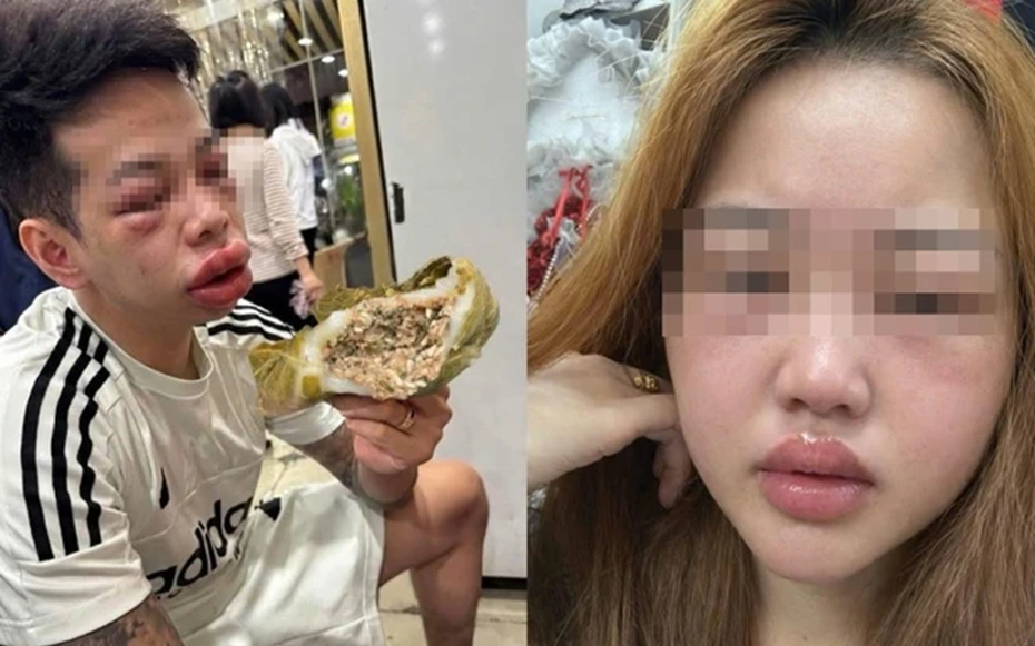 Ăn món "lạ" người phụ nữ mặt sưng húp, bác sĩ chỉ mặt điểm tên lý do cực độc