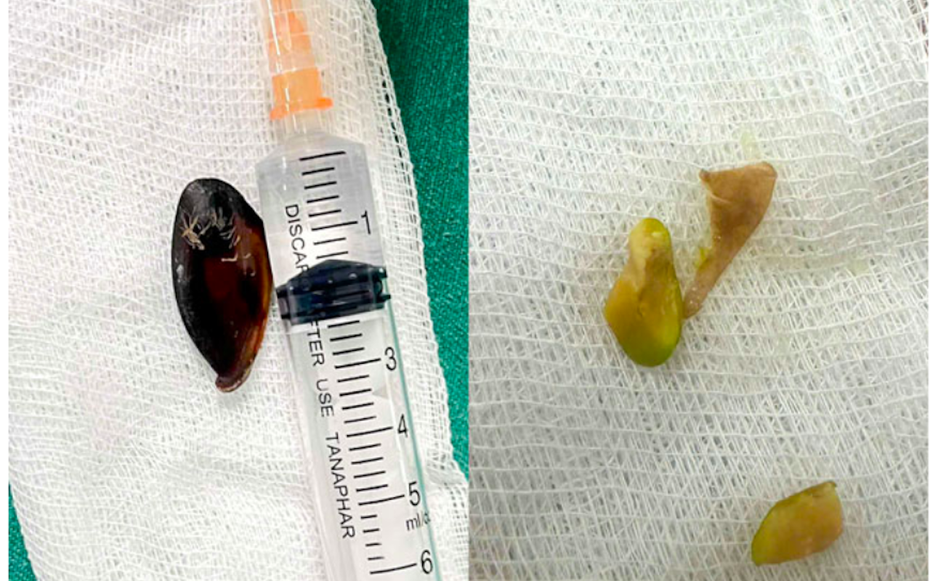 Bé 14 tuổi ho khan kéo dài, gia đình sốc khi bác sĩ lấy ra dị vật bên trong cơ thể