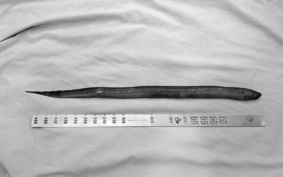 Người đàn ông 41 tuổi đau dữ dội, bác sĩ "sốc ngang" thấy con lươn dài 50cm trong bụng