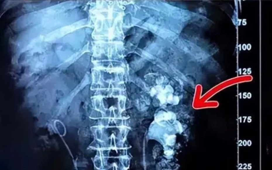 Cô gái trẻ nhập viện, bác sĩ phát hiện hai bên thận chi chít sỏi vì món đồ uống yêu thích