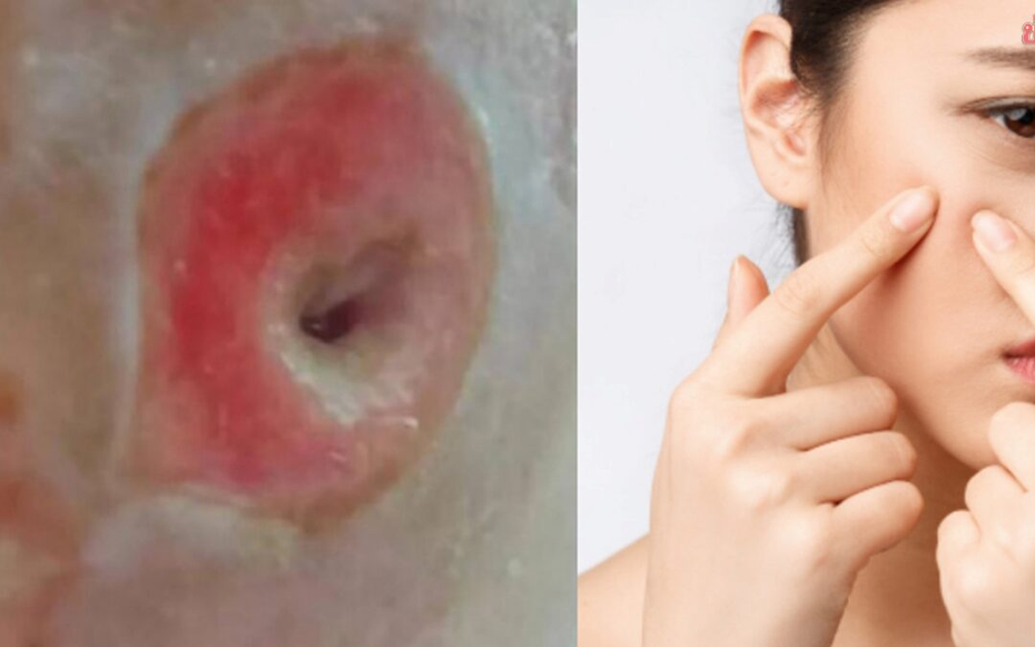 Người phụ nữ 40 tuổi chết lặng khi thấy mặt như "tổ ong" vì sai lầm ai cũng dễ mắc