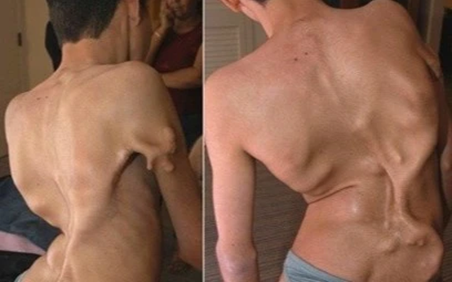 Bé gái 12 tuổi mắc hội chứng "người hóa đá" cực hiếm, cả triệu người mới có một ca