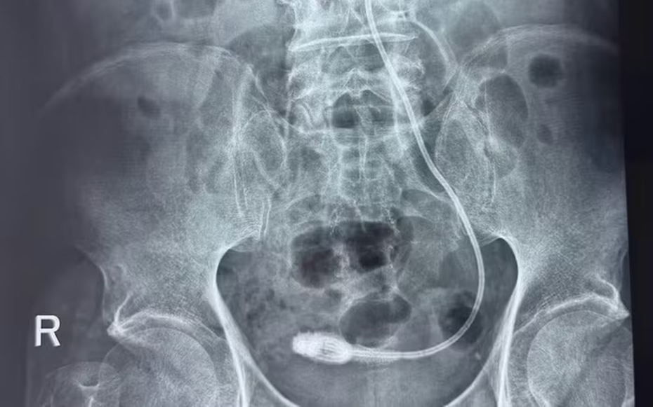 Quên tái khám sau tán sỏi, cụ ông 73 tuổi "sốc" khi phát hiện bí mật nằm trong cơ thể 9 năm