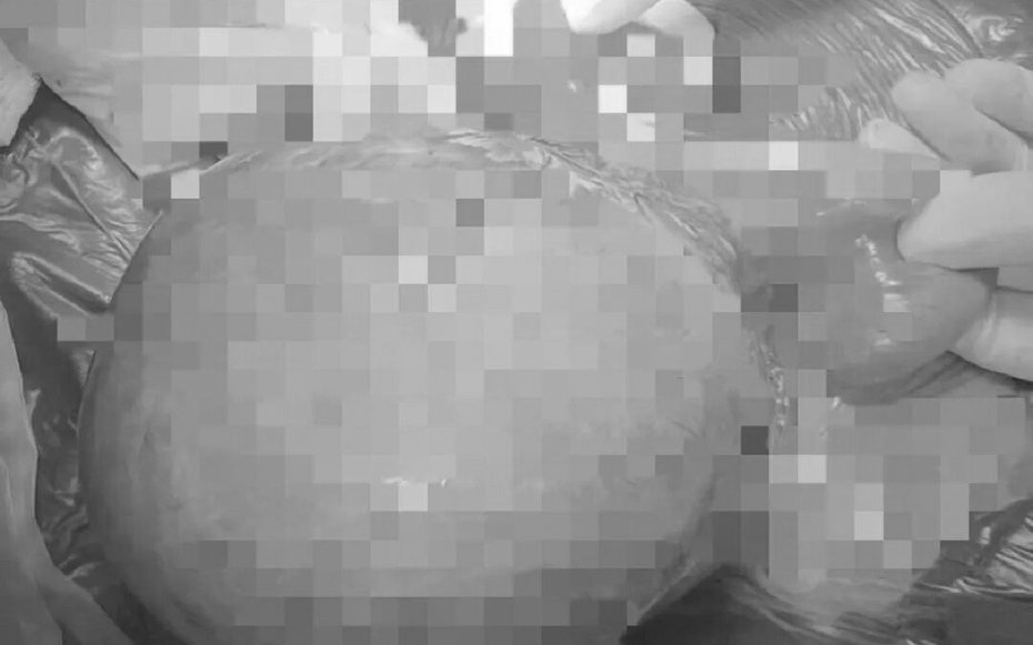Bé trai 9 tuổi đau bụng suốt 1 năm, bố mẹ sốc khi bác sĩ lấy ra thứ "đáng sợ" bên trong