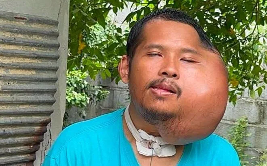 Xỉa răng sai cách, người đàn ông 31 tuổi có khuôn mặt "đáng sợ"
