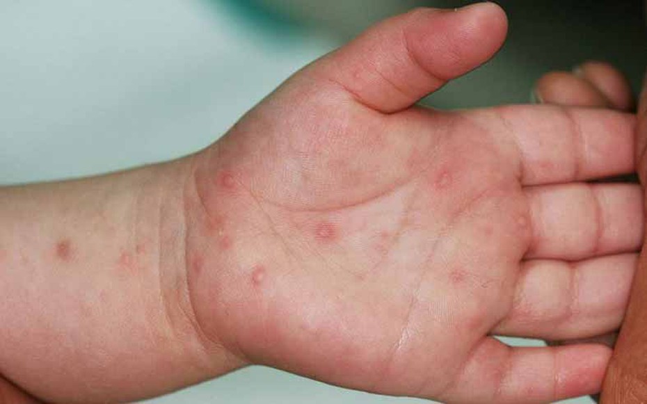 Tp.HCM ghi nhận số ca tay chân miệng tăng 47% trong một tuần