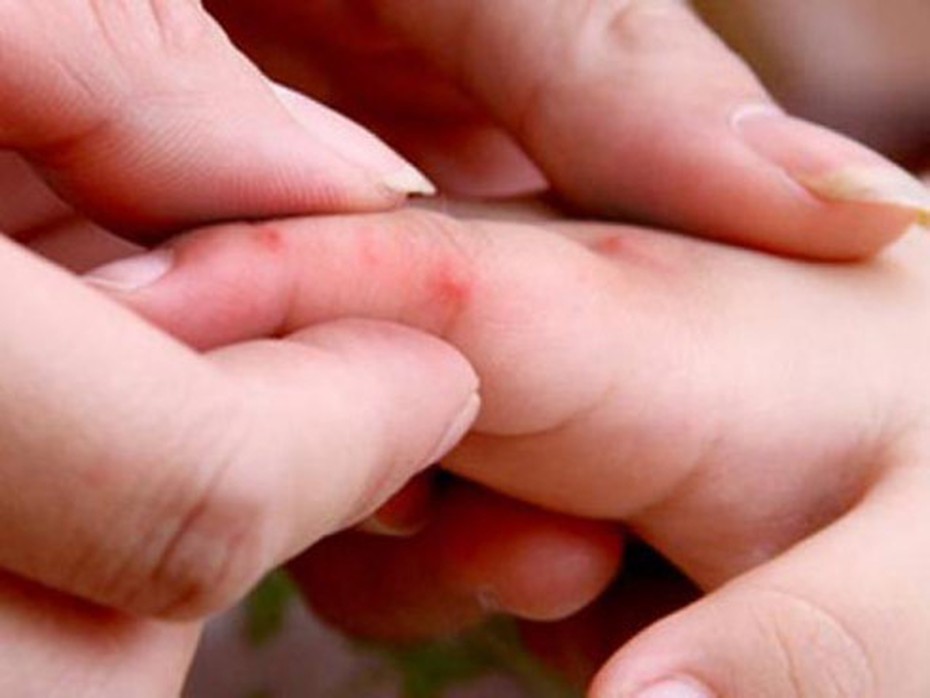 Hơn 60.000 ca mắc tay chân miệng, nguy cơ dịch chồng dịch