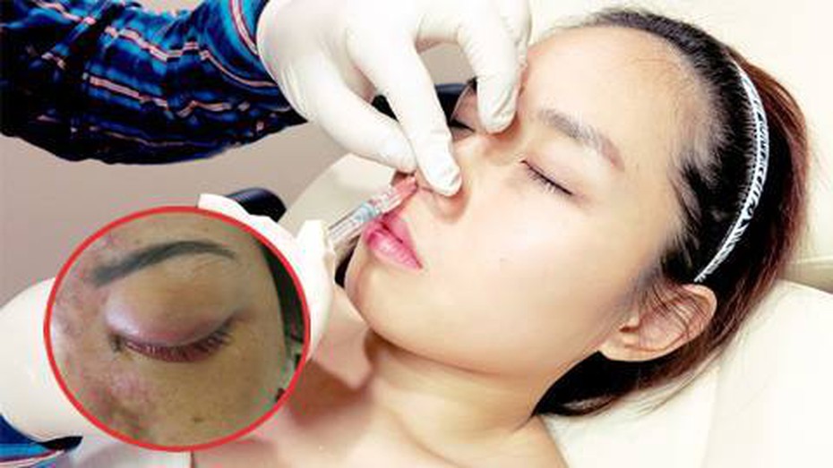 Điểm mặt hàng loạt những vụ tiêm filler dẫn đến mù mắt, hoại tử